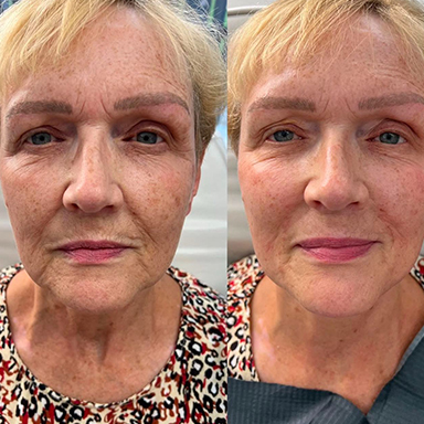 Skin Rejuvenation
