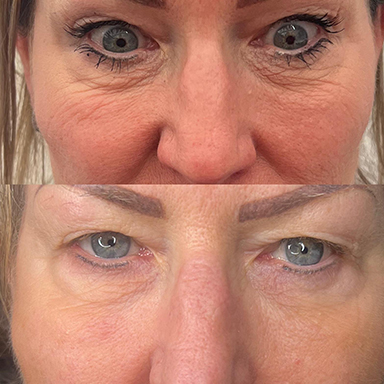 Resurfacing Results